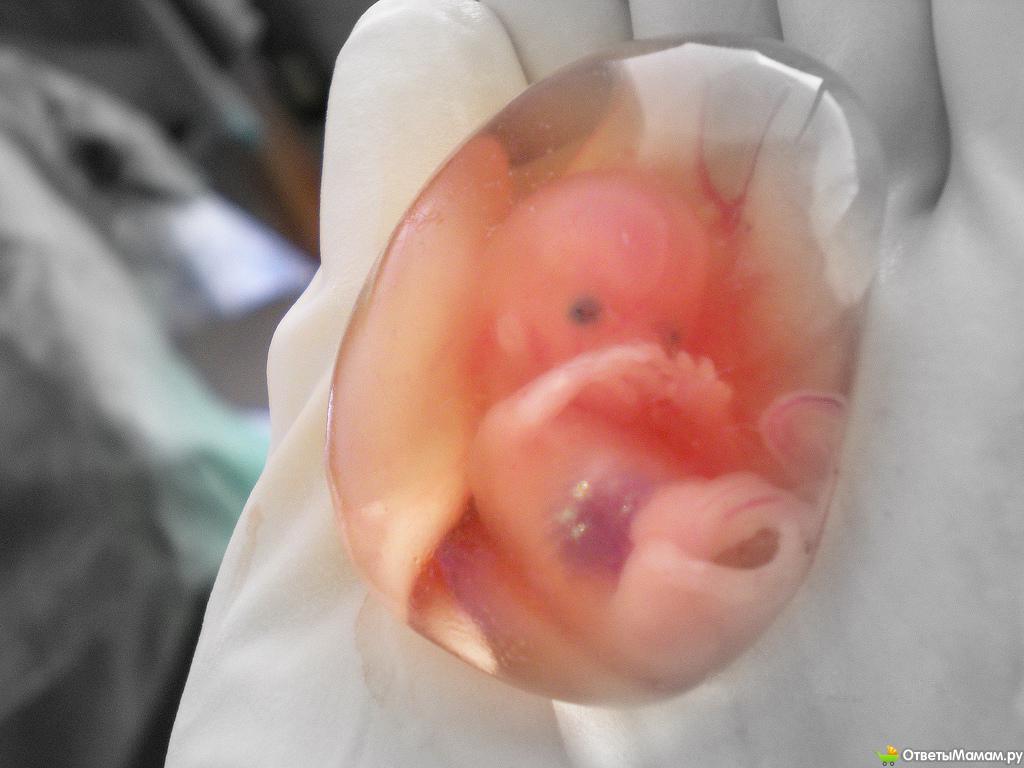 Фото Эмбриона На 11 Неделе Беременности