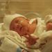  Острая асфиксия новорожденного – удушье при рождении