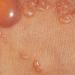 лечение пузырчатого дерматита