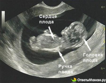 9 неделя беременности, фото с УЗИ