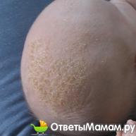 крочки на голове у младенца