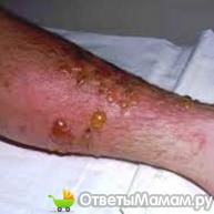 пузырчатый дерматит на ноге
