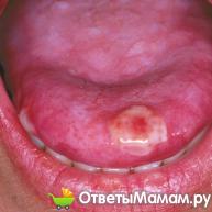 пузырчатый дерматит на слизистой рта