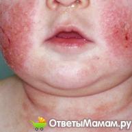 пузырчатый дерматит у ребенка
